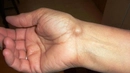 Ganglion Kisti Belirtileri ve Tedavisi