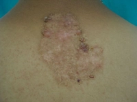 Lenfanjiom Belirtileri ve Tedavisi