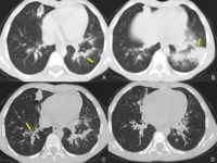 Anekoik Kist Tedavisi