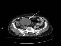 Sağ Overde Kist Belirtileri ve Tedavisi