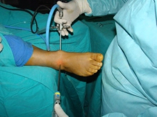 Ayak Bileğinde Kist Belirtileri ve Tedavisi