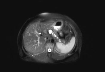 Komplike Kist Belirtileri ve Tedavisi