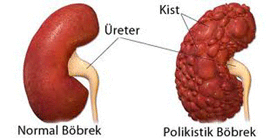 Baker kisti, belirtileri ve tedavisi Baker kisti, belirtileri ve tedavisi